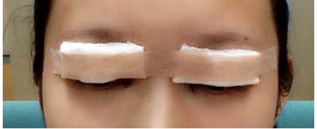 全切雙眼皮去皮去脂開(kāi)眼角恢復(fù)過(guò)程