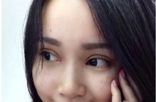 全切雙眼皮+去皮去脂+開(kāi)眼角一個(gè)月了~