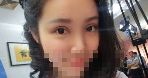 全切雙眼皮+去皮去脂+開(kāi)眼角一個(gè)月了~