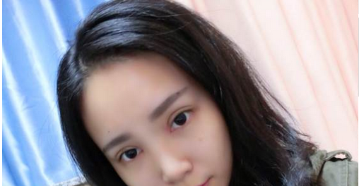 全切雙眼皮+去皮去脂+開(kāi)眼角一個(gè)月了~