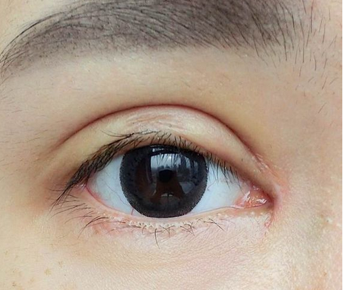 全切雙眼皮+去皮去脂+開(kāi)眼角一個(gè)月了~