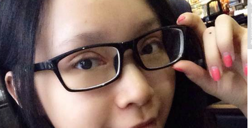 全切雙眼皮+去皮去脂+開(kāi)眼角一個(gè)月了~