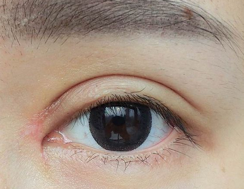 全切雙眼皮+去皮去脂+開(kāi)眼角一個(gè)月了~