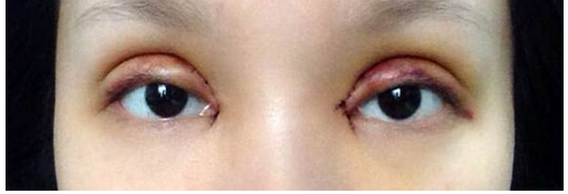 全切雙眼皮+去皮去脂+開(kāi)眼角一個(gè)月了~