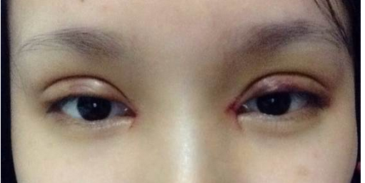 全切雙眼皮+去皮去脂+開(kāi)眼角一個(gè)月了~