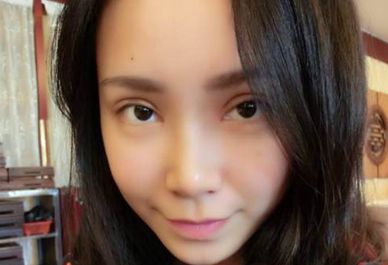 全切雙眼皮+去皮去脂+開(kāi)眼角一個(gè)月了~