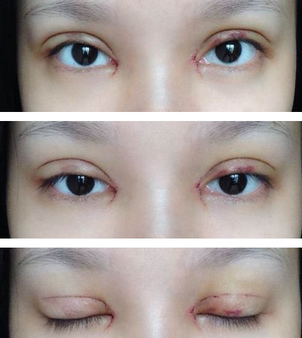 全切雙眼皮+去皮去脂+開(kāi)眼角一個(gè)月了~