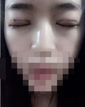 做埋線雙眼皮一周啦~果滿滿的！