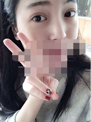 做埋線雙眼皮一周啦~果滿滿的！