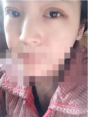 做埋線雙眼皮一周啦~果滿滿的！