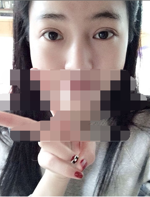 做埋線雙眼皮一周啦~果滿滿的！