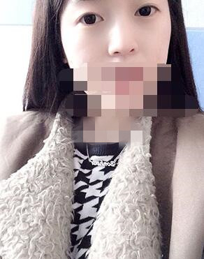 做埋線雙眼皮一周啦~果滿滿的！