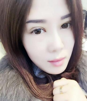 雙眼皮恢復記錄 果很滿意~