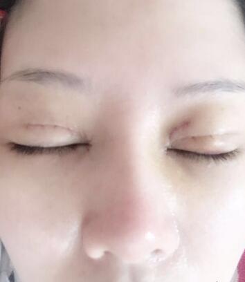 雙眼皮恢復記錄 果很滿意~