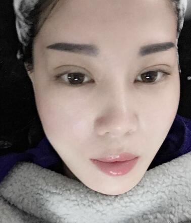 雙眼皮恢復記錄 果很滿意~