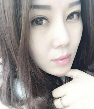 雙眼皮恢復記錄 果很滿意~