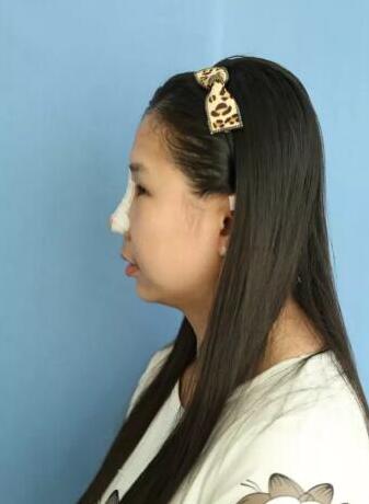 項昌峰醫(yī)生做的隆鼻整形速來看看果怎么樣