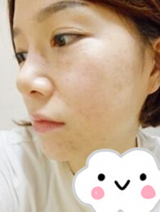 光子嫩膚 我的皮膚也可以白皙Q彈啦~