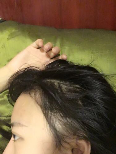 成都玉之光頭發(fā)移植 果杠杠的~