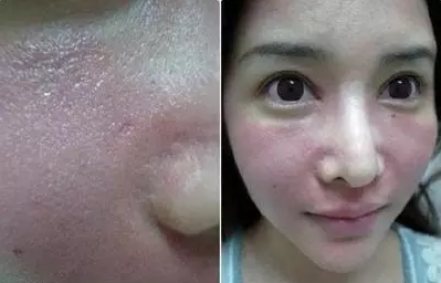 成都玉之光激光嫩膚經(jīng)歷 愛美的MM一定要看