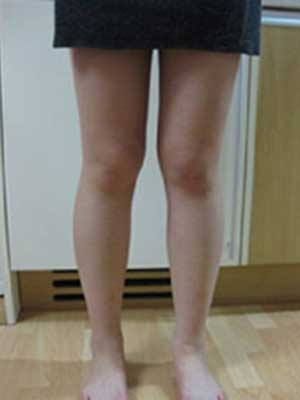 北京禾美嘉大腿吸脂 給大家分享一下體驗(yàn)