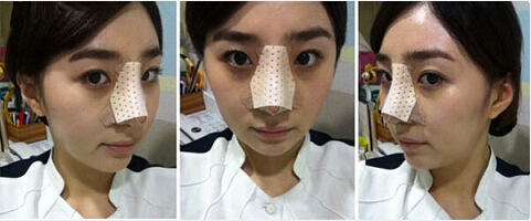 深圳希思崔院長(zhǎng)隆鼻整形 擺脫了豬妹妹的稱號(hào)