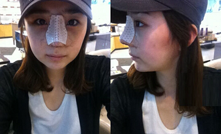 深圳希思崔院長(zhǎng)隆鼻整形 擺脫了豬妹妹的稱號(hào)