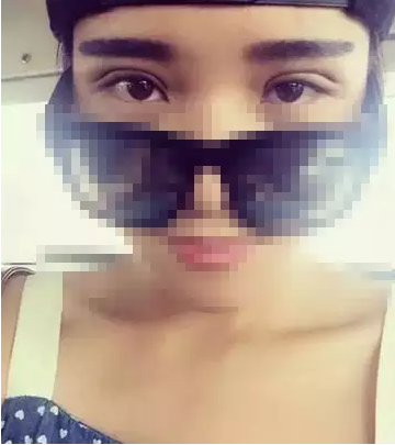 深圳希思做的雙眼皮 現(xiàn)在美美的