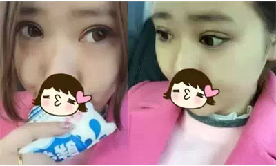 深圳希思做的雙眼皮+開(kāi)眼角 感謝楊醫(yī)師！