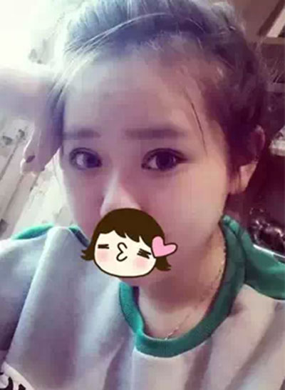 深圳希思做的雙眼皮+開(kāi)眼角 感謝楊醫(yī)師！