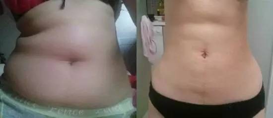 北京炫美腹部吸脂術(shù)后 穿衣服更有型了!