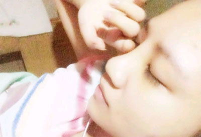 假體隆鼻15天后恢復(fù)果 杭州時(shí)光做的~