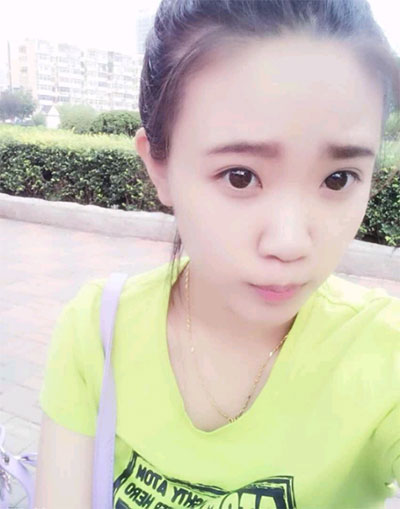 假體隆鼻15天后恢復(fù)果 杭州時(shí)光做的~