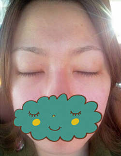 杭州時光激光去眼袋1個月了