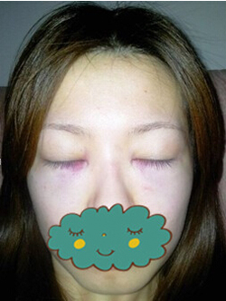 杭州時光激光去眼袋1個月了