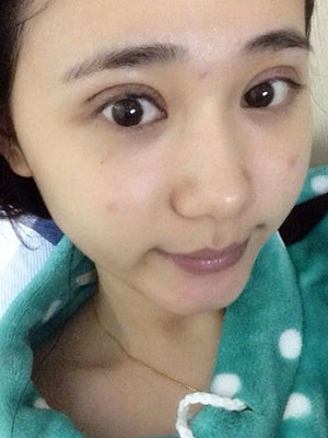 北京常好麗格割雙眼皮一周啦~