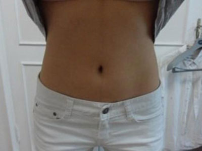 北京常好麗格腰腹吸脂后20天的感受 恢復日記來咯~