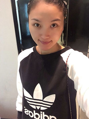 北京常好麗格做假體隆鼻3個(gè)月