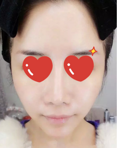 做了拉皮除皺 我的皮膚越來越緊致光滑了