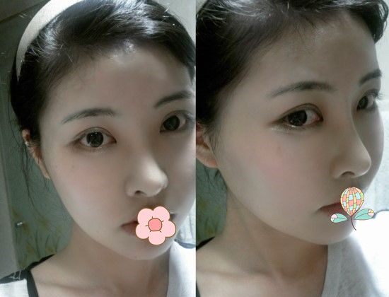 做了磨顴骨手術(shù)的我從小鴨子變成白天鵝 謝謝柳大烈教授