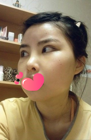 做了磨顴骨手術(shù)的我從小鴨子變成白天鵝 謝謝柳大烈教授