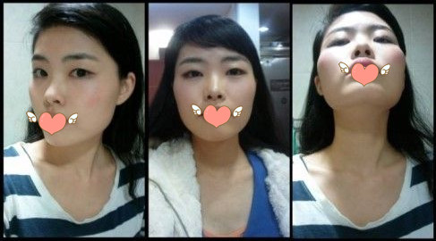 做了磨顴骨手術(shù)的我從小鴨子變成白天鵝 謝謝柳大烈教授