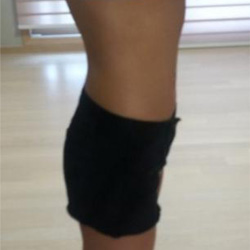 北京清木腰腹吸脂3個(gè)月感受