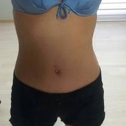 北京清木腰腹吸脂3個(gè)月感受