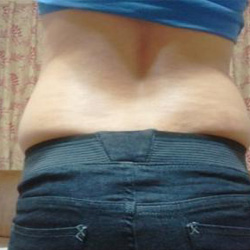 北京清木腰腹吸脂3個(gè)月感受