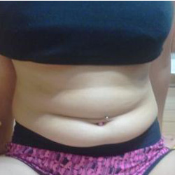 北京清木腰腹吸脂3個(gè)月感受