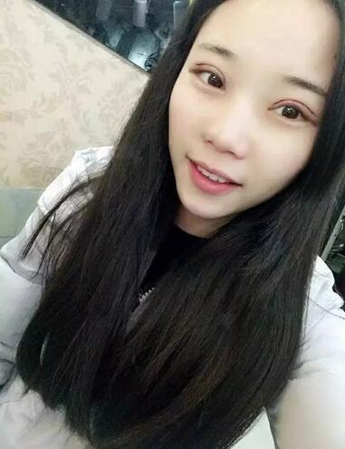 成都蜀尚蓉雅雙眼皮恢復(fù)紀(jì)實(shí) 看看果怎么樣