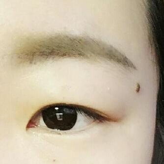雙眼皮恢復(fù)過程分享