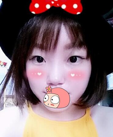 雙眼皮恢復(fù)過程分享