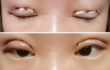 雙眼皮恢復(fù)過程分享